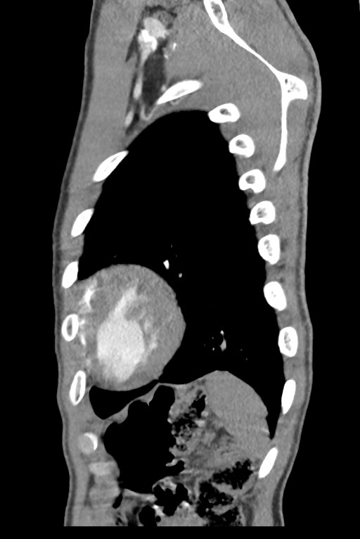 Aortic coarctation with aneurysm (Radiopaedia 74818-85828 B 137).jpg