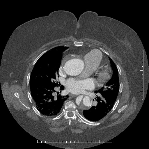 Aortic dissection- Stanford A (Radiopaedia 35729-37268 A 47).jpg