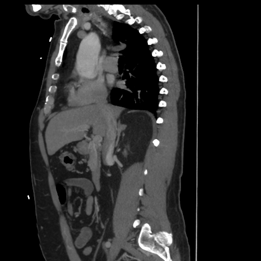File:Aortic dissection- Stanford A (Radiopaedia 37759-39664 Sagittal C+ delayed 9).png