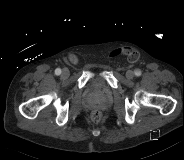 Aortic dissection (CTPA) (Radiopaedia 75506-86750 E 151).jpg