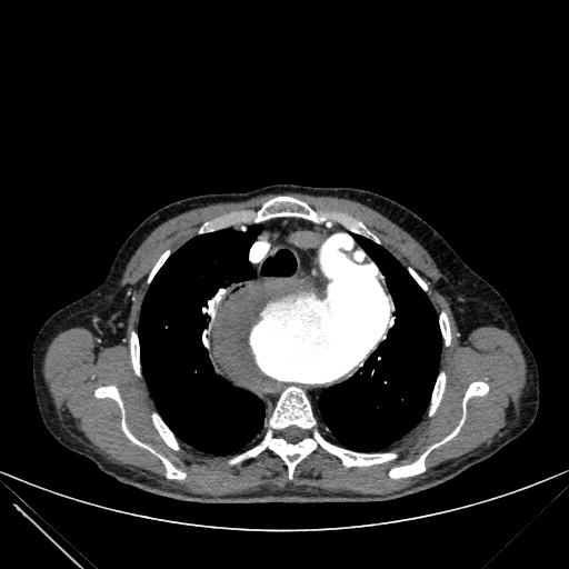 Aortic dissection (Radiopaedia 27466-27665 C+ arterial phase 43).jpg