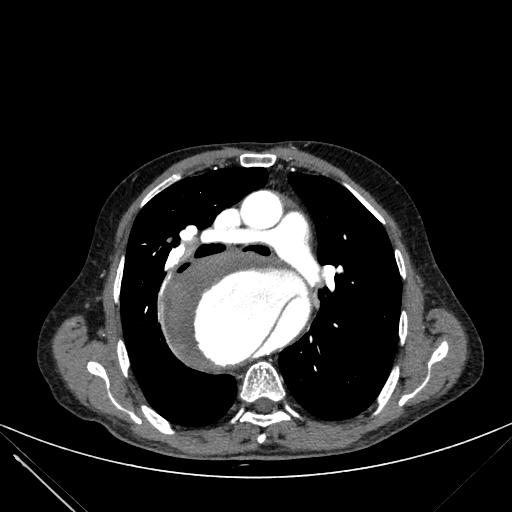 Aortic dissection (Radiopaedia 27466-27665 C+ arterial phase 99).jpg
