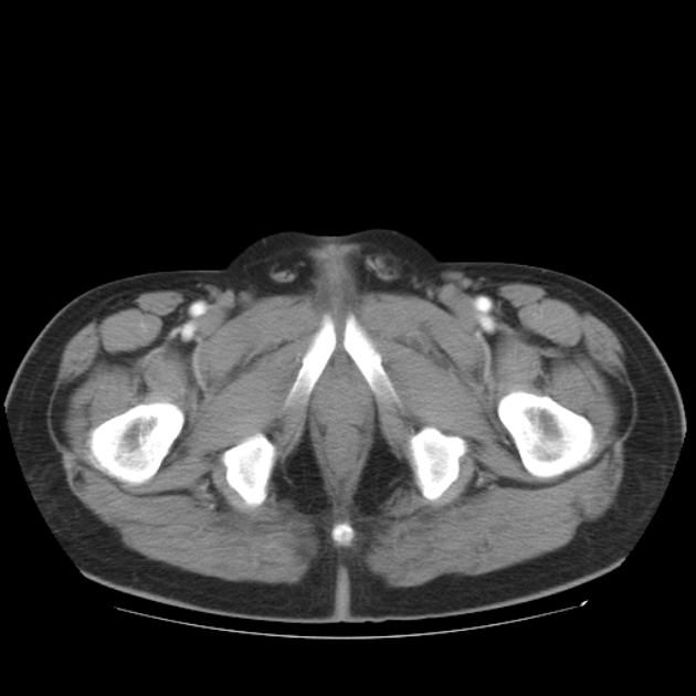Aortic dissection (Radiopaedia 44411-48061 C 60).jpg