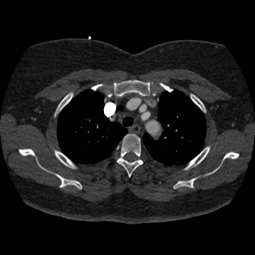 Aortic dissection (Radiopaedia 57969-64959 A 75).jpg