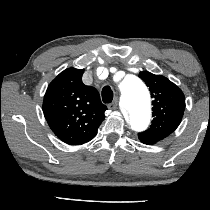 Aortic dissection - DeBakey Type I-Stanford A (Radiopaedia 79863-93115 A 7).jpg