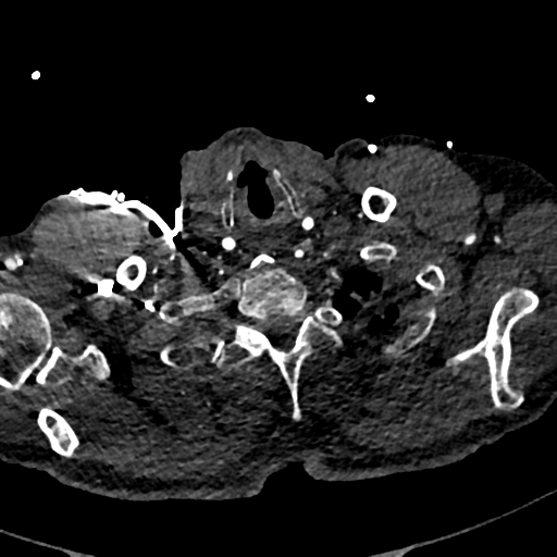 Aortic dissection - DeBakey type II (Radiopaedia 64302-73082 A 7).png
