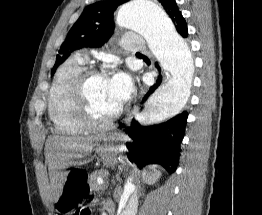 Aortic dissection - Stanford A -DeBakey I (Radiopaedia 28339-28587 C 54).jpg