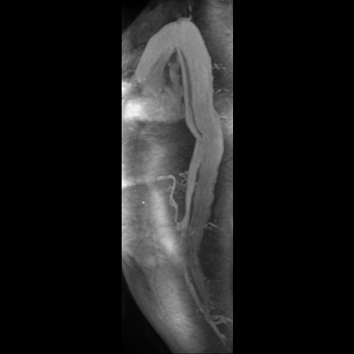 File:Aortic dissection - Stanford A - DeBakey I (Radiopaedia 23469-23551 D 4).jpg