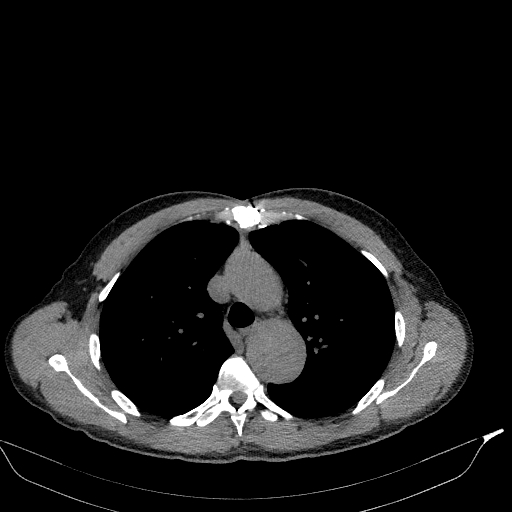 File:Aortic dissection - Stanford type A (Radiopaedia 83418-98500 Axial non-contrast 14).jpg
