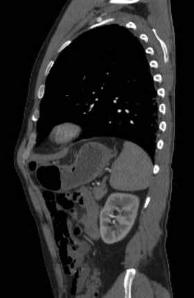 File:Aortic dissection - Stanford type B (Radiopaedia 73648-84437 C 36).jpg