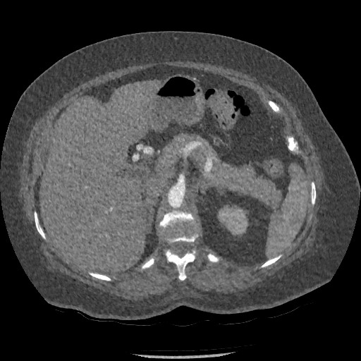 Aortic dissection - Stanford type B (Radiopaedia 88281-104910 A 105).jpg