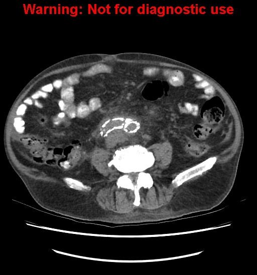 Aortic graft infection (Radiopaedia 44979-48907 Axial non-contrast 59).jpg