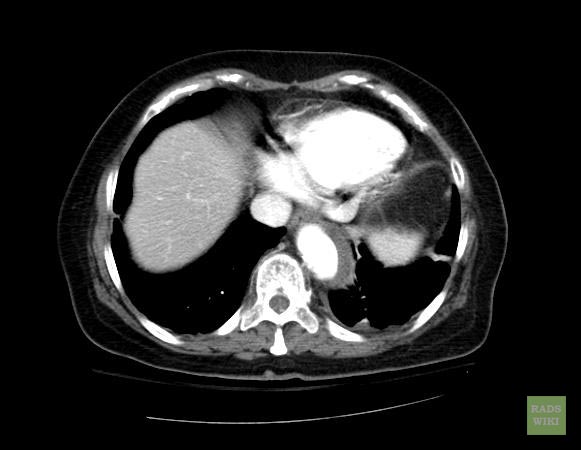 File:Aortic intramural hematoma (Radiopaedia 11198-11562 F 1).jpg