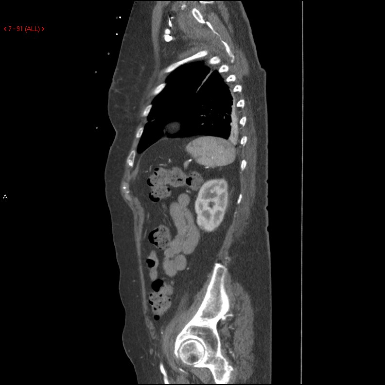 Aortic intramural hematoma (Radiopaedia 27746-28001 C 60).jpg