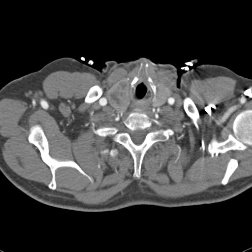 Aortic intramural hematoma (Radiopaedia 31139-31838 B 4).jpg