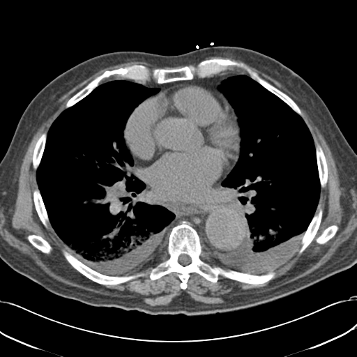 Aortic intramural hematoma (Radiopaedia 34260-35540 Axial non-contrast 36).png