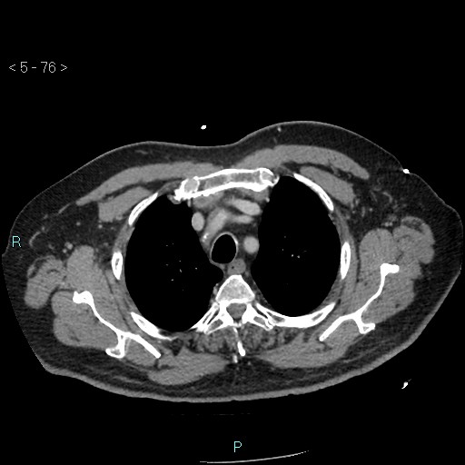 Aortic intramural hematoma (Radiopaedia 48463-53380 C 36).jpg