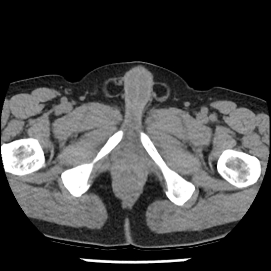 Aortic intramural hematoma (type B) (Radiopaedia 79323-92387 Axial non-contrast 121).jpg