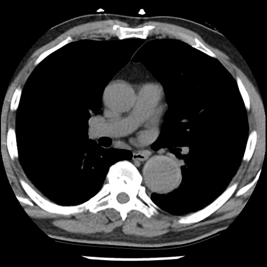 Aortic intramural hematoma (type B) (Radiopaedia 79323-92387 Axial non-contrast 25).jpg