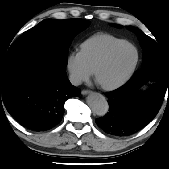 Aortic intramural hematoma (type B) (Radiopaedia 79323-92387 Axial non-contrast 39).jpg