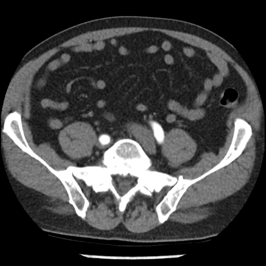 File:Aortic intramural hematoma (type B) (Radiopaedia 79323-92387 B 90).jpg