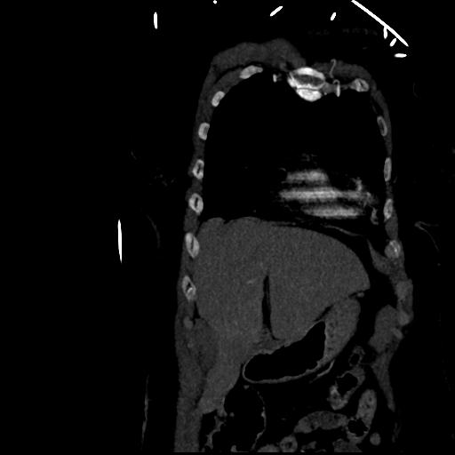 Aortic intramural hematoma from penetrating atherosclerotic ulcer (Radiopaedia 31137-31836 C 11).jpg