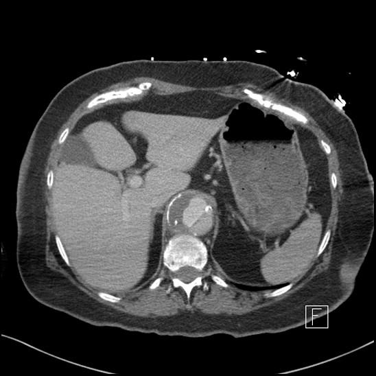 Aortic intramural hematoma with dissection and intramural blood pool (Radiopaedia 77373-89491 E 7).jpg