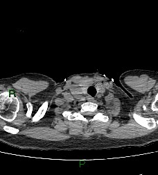 Aortic valve endocarditis (Radiopaedia 87209-103485 Axial non-contrast 8).jpg