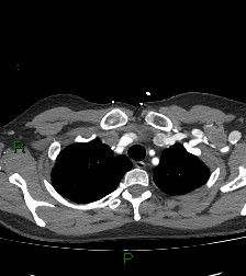 File:Aortic valve endocarditis (Radiopaedia 87209-103485 C 15).jpg