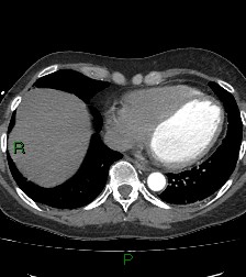 Aortic valve endocarditis (Radiopaedia 87209-103485 C 69).jpg