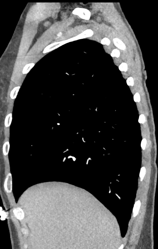 Aortic valve non-coronary cusp thrombus (Radiopaedia 55661-62189 C+ arterial phase 59).png