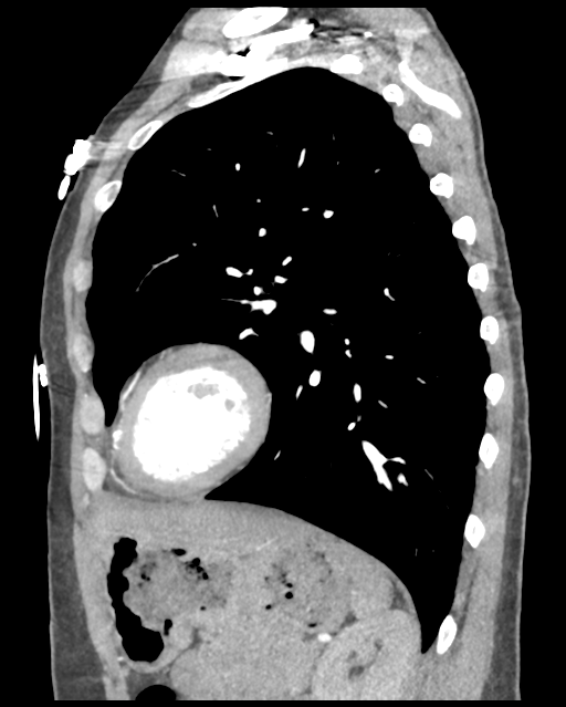 Aortic valve non-coronary cusp thrombus (Radiopaedia 55661-62189 D 18).png