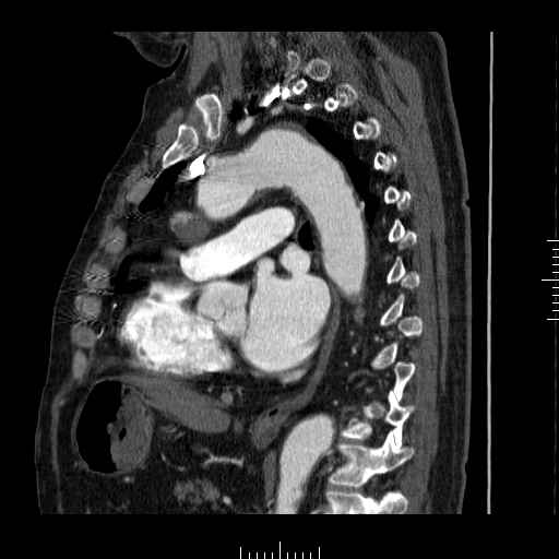 File:Aorto-coronary bypass graft aneurysms (Radiopaedia 40562-43157 C 22).png