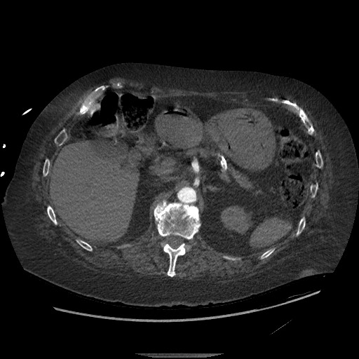 Aortoesophageal fistula with endovascular repair (Radiopaedia 73781-84592 Axial C+ CTPA 193).jpg