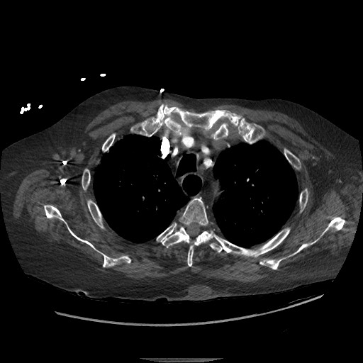 File:Aortoesophageal fistula with endovascular repair (Radiopaedia 73781-84592 Axial C+ CTPA 22).jpg