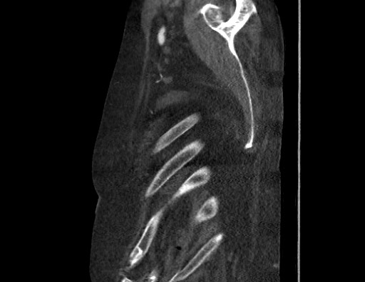 Aortoesophageal fistula with endovascular repair (Radiopaedia 73781-84592 Sagittal C+ CTPA 188).jpg