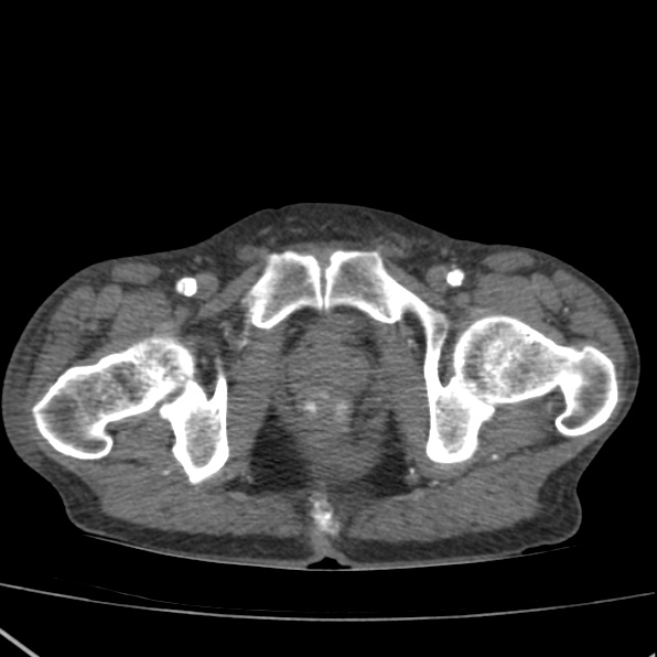 Aortoiliac occlusive disease (Radiopaedia 32134-33076 G 90).jpg