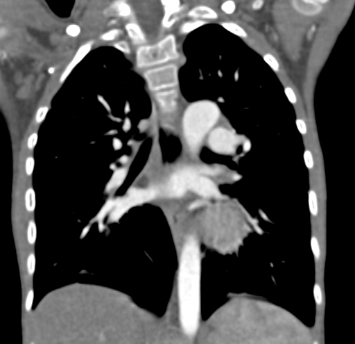 File:Aortopulmonary window, interrupted aortic arch and large PDA giving the descending aorta (Radiopaedia 35573-37074 D 43).jpg