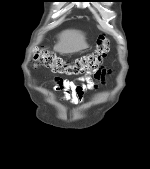 File:Appendiceal abscesses (Radiopaedia 50999-56542 Coronal non-contrast 12).png
