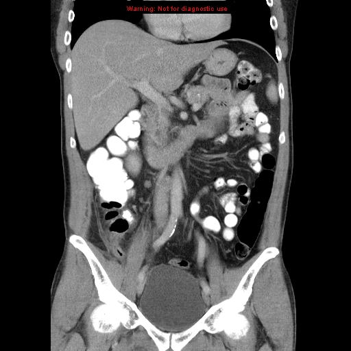 File:Appendicitis and renal cell carcinoma (Radiopaedia 17063-16760 B 14).jpg
