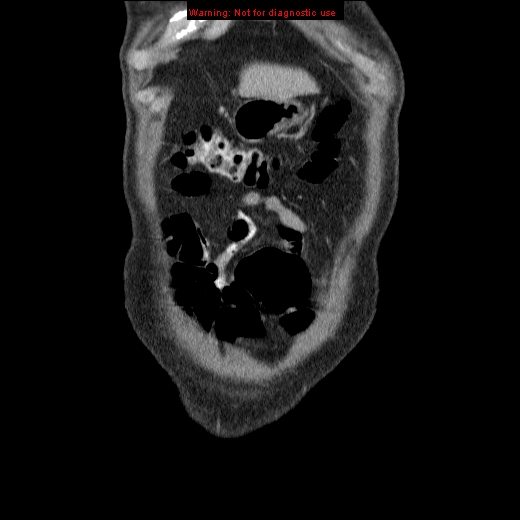 File:Appendicitis mass in inguinal hernia (Radiopaedia 26858-27029 B 3).jpg