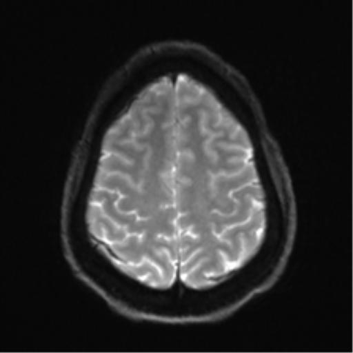 Arachnoid cyst - cerebellopontine angle (Radiopaedia 59689-67083 Axial DWI 29).png