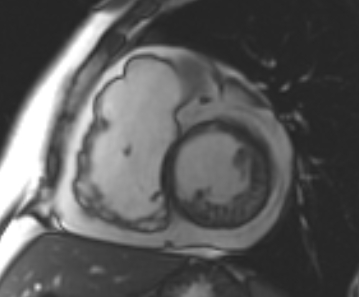 Arrhythmogenic right ventricular cardiomyopathy (Radiopaedia 69431-79307 Short axis cine 144).jpg
