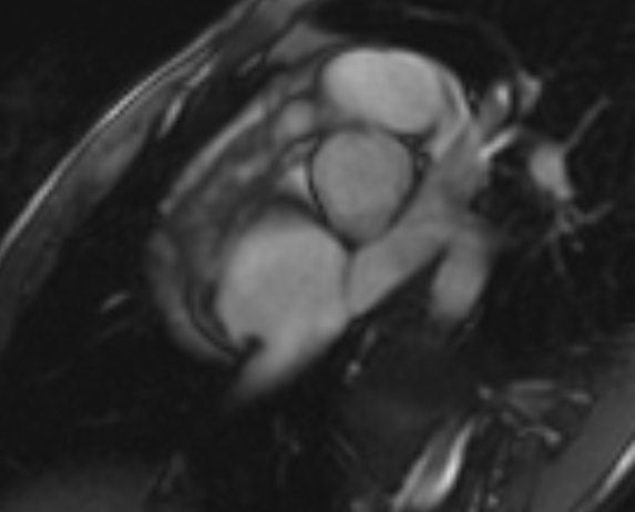 Arrhythmogenic right ventricular cardiomyopathy (Radiopaedia 69564-79464 short axis cine 282).jpg