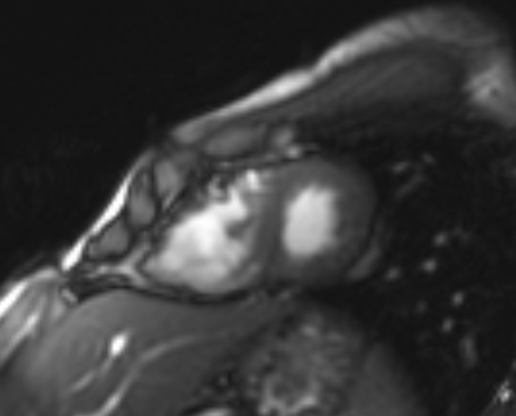Arrhythmogenic right ventricular cardiomyopathy (Radiopaedia 69564-79464 short axis cine 68).jpg