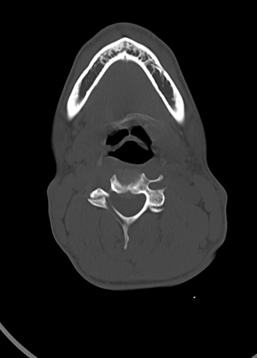 Arrow injury to the head (Radiopaedia 75266-86388 Axial bone window 15).jpg