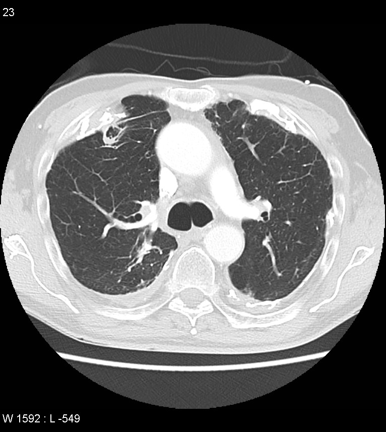 Asbestos related lung and pleural disease (Radiopaedia 14377-14301 A 20).jpg
