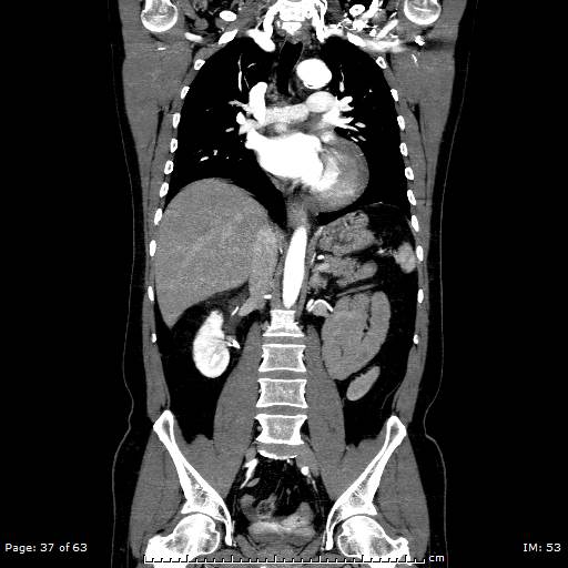 Ascending aortic aneurysm (Radiopaedia 50086-55404 B 37).jpg