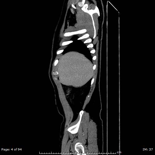 Ascending aortic aneurysm (Radiopaedia 50086-55404 C 3).jpg