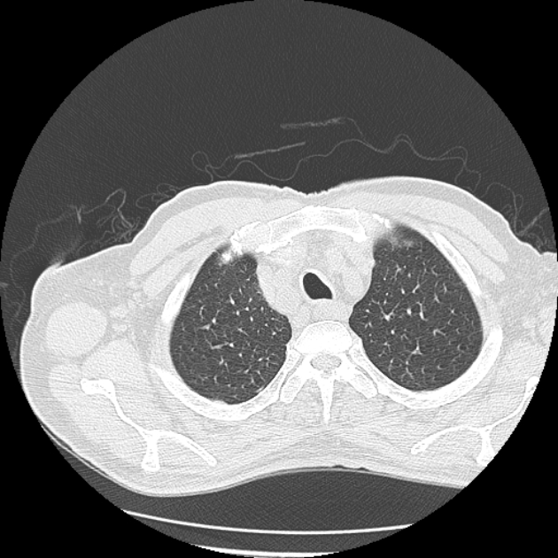 Aspergilloma (Radiopaedia 44592-48327 Axial lung window 9).jpg
